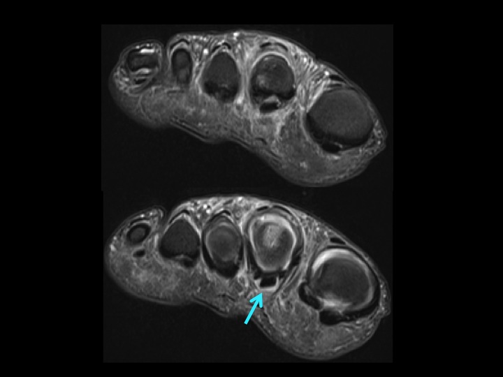 Figure 2 for case Freibergs Infraction with 2nd MTPJ plantar plate and lateral capsule tear
